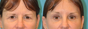 Browlift Before and After Photos Brow Lift