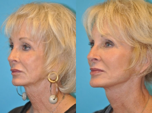 facelift procedures before and after photos