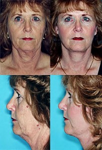 Scottsdale Facelift before and after photos