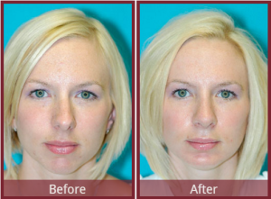chin implant with rhinoplasty in scottsdale