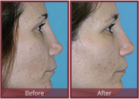 revision rhinoplasty recovery