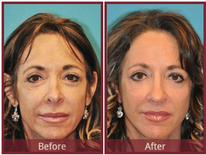 Before and after revision rhinoplasty results showcasing enhanced facial harmony.