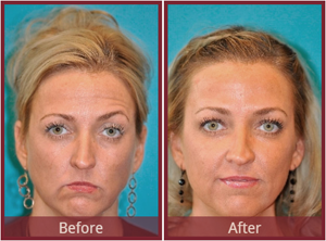 How To Get a Facelift Without Surgery?