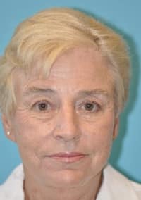 Scottsdale Botox® Before and After Photos