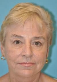 Scottsdale Botox® Before and After Photos