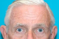 Scottsdale Botox® Before and After Photos