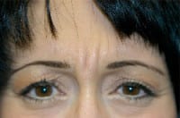 Scottsdale Botox® Before and After Photos