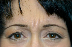Scottsdale Botox® Before and After Photos