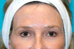 Scottsdale Botox® Before and After Photos