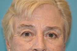 Scottsdale Botox® Before and After Photos