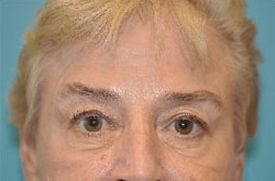 Scottsdale Botox® Before and After Photos