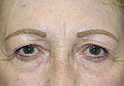 Browlift Before and After Photos Case 3464 Before Photo Browlift Before and After Photos