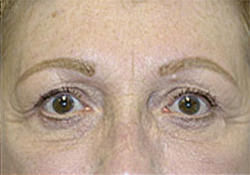 Browlift Before and After Photos Case 3464 After Photo Browlift Before and After Photos