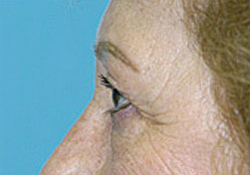 Browlift Before and After Photos Case 3464 Before Photo Browlift Before and After Photos