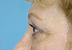 Browlift Before and After Photos Case 3464 After Photo Browlift Before and After Photos