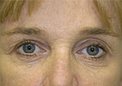 Browlift Before and After Photos Case 3596 Before Photo Browlift Before and After Photos