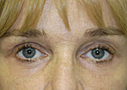 Browlift Before and After Photos Case 3596 After Photo Browlift Before and After Photos