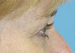 Browlift Before and After Photos Case 3596 Before Photo Browlift Before and After Photos