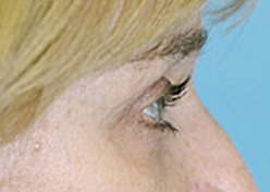 Browlift Before and After Photos Case 3596 After Photo Browlift Before and After Photos