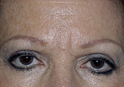 Browlift Before and After Photos