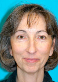 Chin Implant Before and After Photos