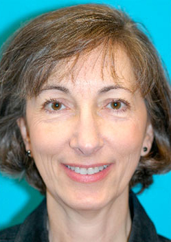 Chin Implant Before and After Photos Case 3490 After Photo Chin Implant Before and After Photos