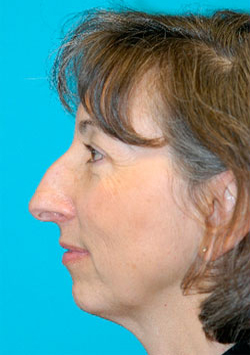 Chin Implant Before and After Photos Case 3490 Before Photo Chin Implant Before and After Photos