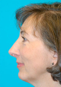 Chin Implant Before and After Photos