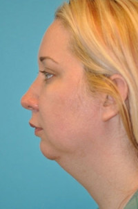 Chin Implant Before and After Photos