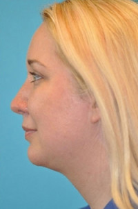 Chin Implant Before and After Photos