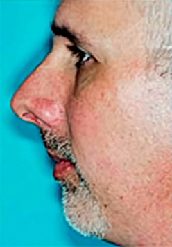 Chin Implant Before and After Photos Case 3609 Before Photo Chin Implant Before and After Photos