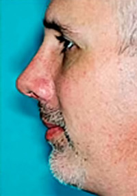 Chin Implant Before and After Photos