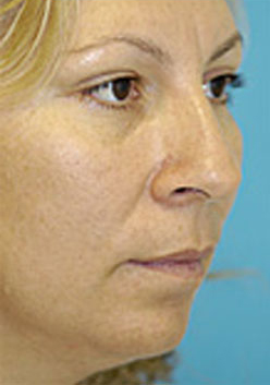 Chin Implant Case 3660 Before Photo Chin Implant