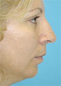 Chin Implant Before and After Photos