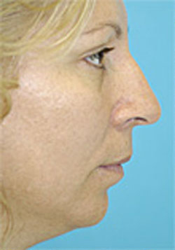 Chin Implant Case 3660 Before Photo Chin Implant