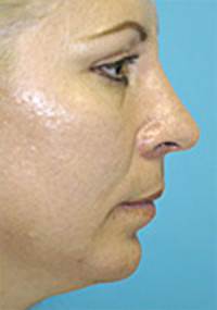 Chin Implant Before and After Photos