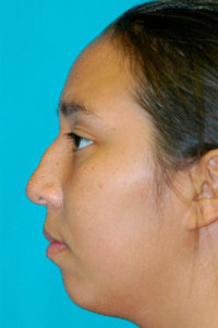 Chin Implant Before and After Photos