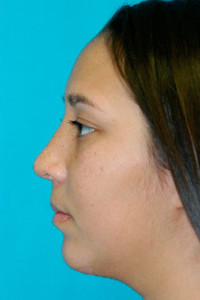 Chin Implant Before and After Photos