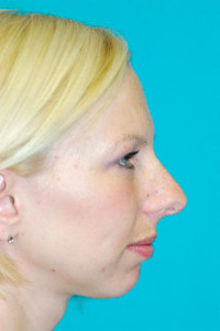 Chin Implant Before and After Photos