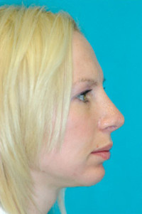 Chin Implant Before and After Photos