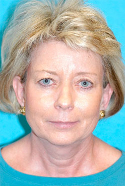 Chin Implant Before and After Photos Case 3800 Before Photo Chin Implant Before and After Photos