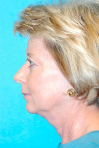 Chin Implant Before and After Photos