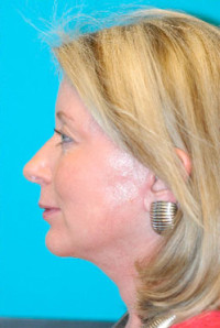 Chin Implant Before and After Photos