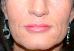Dermal Filler Before and After Photos