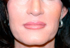 Dermal Filler Before and After Photos