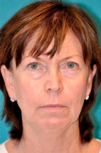 Dermal Filler Before and After Photos