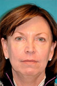 Dermal Filler Before and After Photos