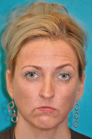 Dermal Filler Before and After Photos Case 4027 Before Photo Dermal Filler Before and After Photos