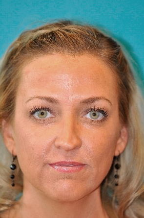 Dermal Filler Before and After Photos Case 4027 After Photo Dermal Filler Before and After Photos