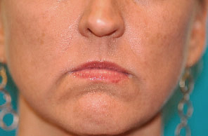Dermal Filler Before and After Photos Case 4027 Before Photo Dermal Filler Before and After Photos